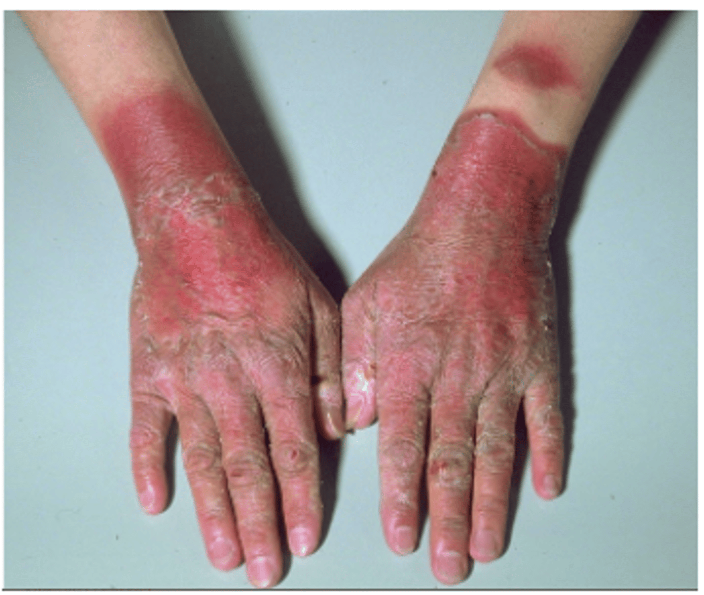 <p>A sixty-eight-year-old man with atherosclerosis and high blood pressure reports to the ER with complaints of “swimming in my head”. His BP is so low it’s difficult to measure. He is severely dehydrated, lips that are dry and cracked, and a dry tongue. His hands are covered by dark, thick, rough, scaly, skin from the knuckles to the tip of the fingers, which they’ve had for months. The rash is on his back, chest, and feet. His partner indicates he has had severe diarrhea for the past several months, going to the bathroom five to ten times a day and at night. His current medications are atorvastatin (a statin for high cholesterol), hydralazine (for high blood pressure), and metformin (for diabetes), all of which he has taken for several years. He eats a well-balanced meals with a good combination of fresh fruits, vegetables, grains, and chicken. Based on this information, which of the following do you think this individual may be deficient for:</p><p>A. Thiamine</p><p>B. Niacin</p><p>C. Pyridoxine</p><p>D. Folate</p><p>E. Cobalamin</p>