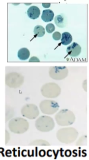 <ul><li><p>Reticulocyte Count (young RBCs)</p><ul><li><p>If reticulocytes high → hemolytic or acute blood loss</p></li><li><p>If reticulocyte count low → decreased RBC production</p></li></ul></li></ul><p></p>