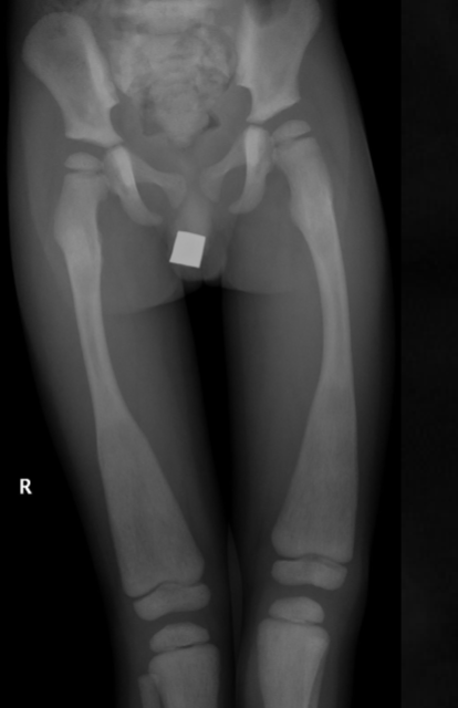 <p>what is seen here for this case of osteopetrosis?</p>