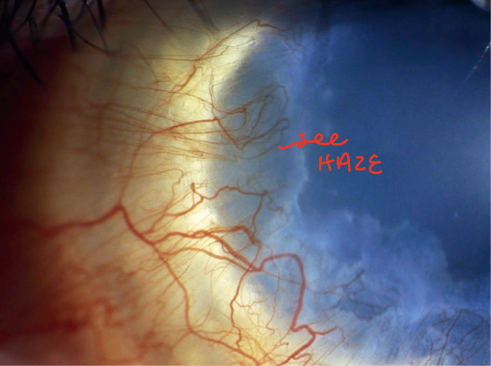 <p>superficial neovascularization with subepithelial degeneration</p>