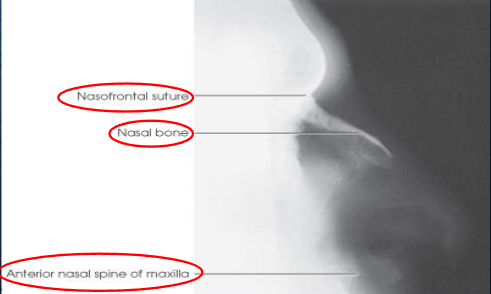 <ul><li><p>shows:</p><ul><li><p>nasal bone and soft tissues of the nose</p></li><li><p>anterior nasal spine</p></li><li><p>frontonasal suture</p></li><li><p>no rotation</p></li></ul></li></ul><p></p>
