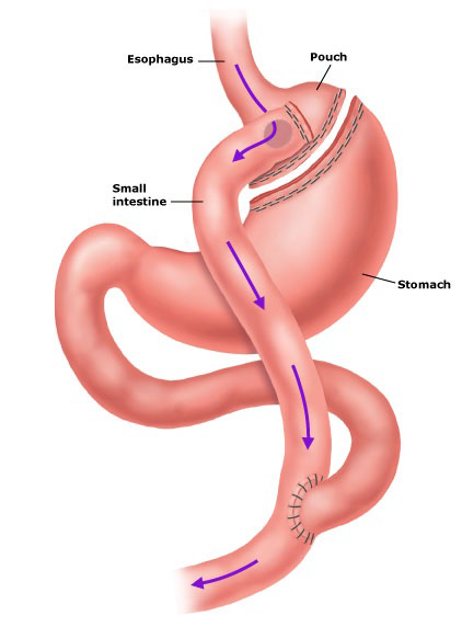 <p>in roux en y surgery, where is the new stomach pouch connected?</p>