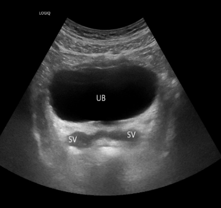 <p>Normal Prostate</p>
