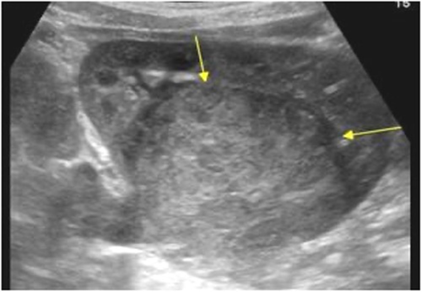 <p>nephroblastoma</p>