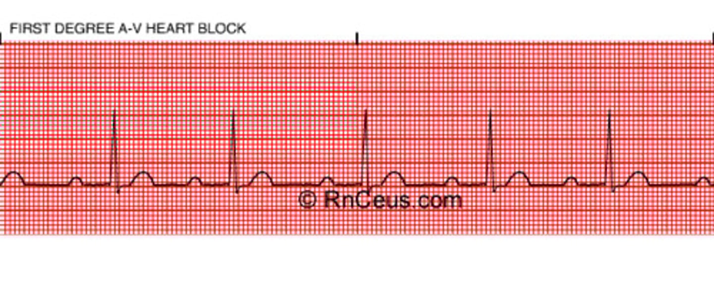 <p>- PRI &gt;5 boxes/.20 sec</p><p>- Fixed but prolonged PRI</p><p>(consistent but long)</p><p>- normally get bradycardia here</p>