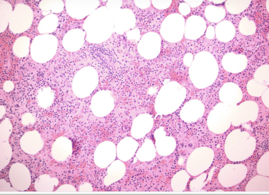<p>sheets of foamy, lipid-laden macrophages</p>