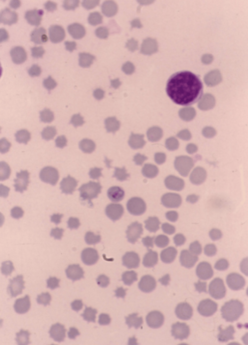 <p>Anisocytosis and crenation (spikes)</p>
