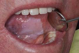 <p><strong>Oral Leukoplakia</strong> is a precursor to what cancer?</p>