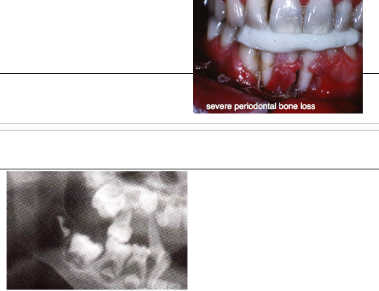 <p><span style="background-color: transparent; font-family: "Times New Roman", serif;">*Related to neutrophil count at nadir</span></p><p><span style="background-color: transparent; font-family: "Times New Roman", serif;"> - recurrent fever, cervical lymphadenopathy, pharyngitis, malaise, ulcerations of GI tract</span><br></p><p><span style="background-color: transparent; font-family: "Times New Roman", serif;">ORAL:</span></p><p><span style="background-color: transparent; font-family: "Times New Roman", serif;"><strong>*Ulceration of mucosa with minor trauma </strong></span></p><p><span style="background-color: transparent; font-family: "Times New Roman", serif;"><strong> - <u>gingiva</u>, lips, tongue, buccal mucosa</strong></span></p><p><span style="background-color: transparent; font-family: "Times New Roman", serif;"> - with reduced neutrophilic infiltrate</span></p><p><span style="background-color: transparent; font-family: "Times New Roman", serif;"><strong>*Severe periodontal bone loss</strong></span></p><p><span style="background-color: transparent; font-family: "Times New Roman", serif;"><strong>*Tooth mobility</strong></span></p><p><span style="background-color: transparent; font-family: "Times New Roman", serif;"><strong>*Marked gingival recession</strong></span></p>