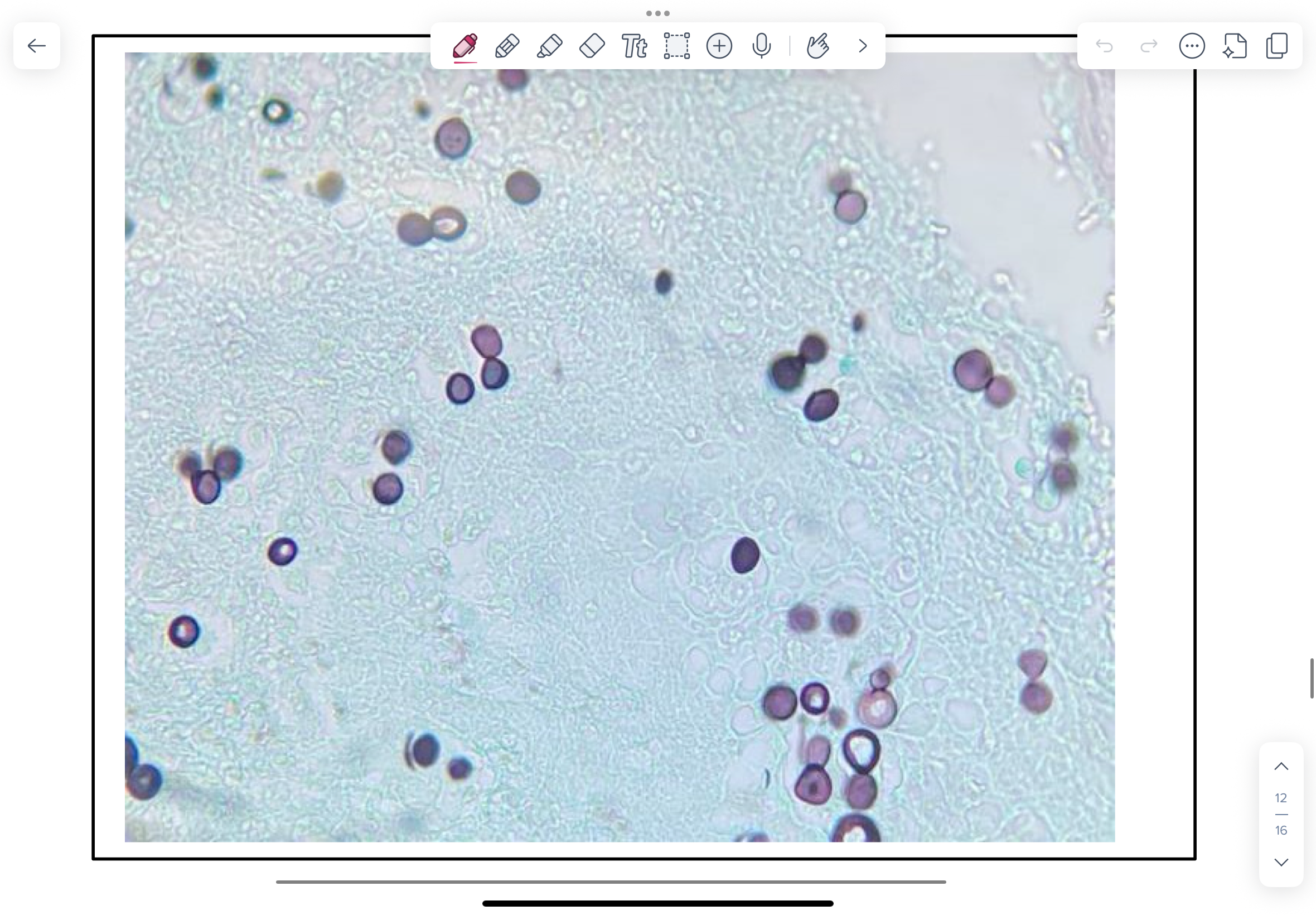 <p>Lungs (transtracheal aspirates), skin (exudates/aspirates), and brain (CSF) are sites where lesions commonly develop and would demonstrate Blastomyces dermatitidis yeast.</p><p>Methenamine silver-stained lung section from a dog with blastomycosis</p><p>NOTE large (8.0-15.0 µm), double-layered, envelope, budding yeast with a wide-base between mother and daughter cells.</p>