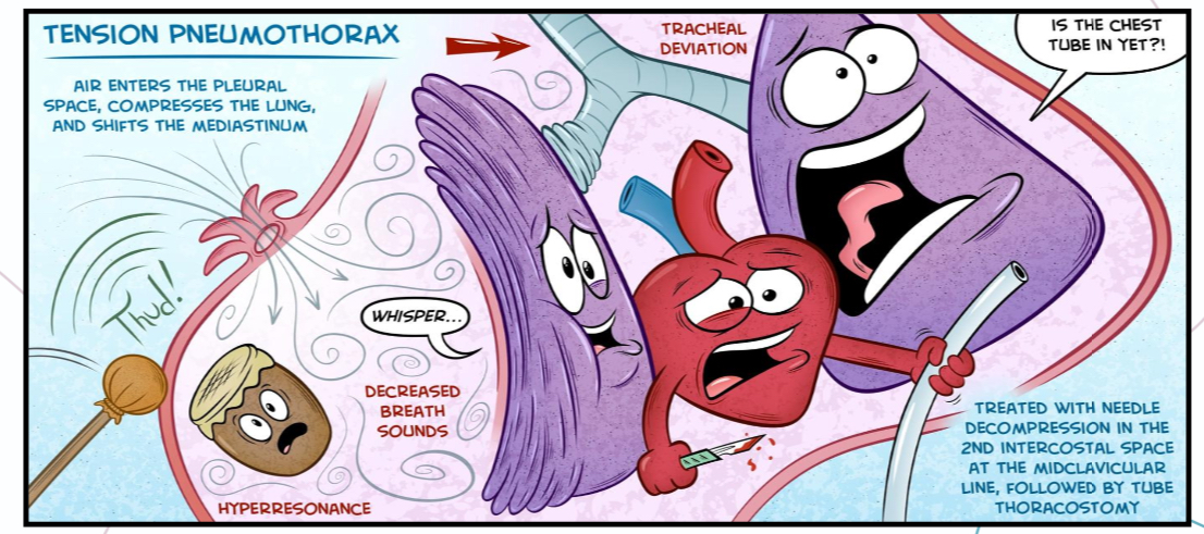 <p>Air compresses the lungs, shifts the trachea and the mediastinum</p><p>The affected lung on the ipslateral pneumothorax is collapse and the lung, heart, blood vessels contralateral are pressurised </p><p></p>