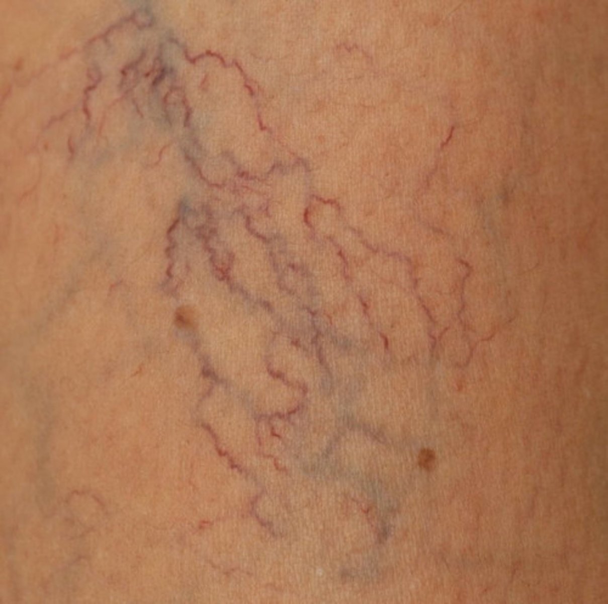 <p>blue superficial varicose veins with legs</p>