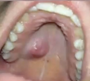 <p>Slowly growing lesion. Been present for over 10 years. What is the diagnosis?</p>