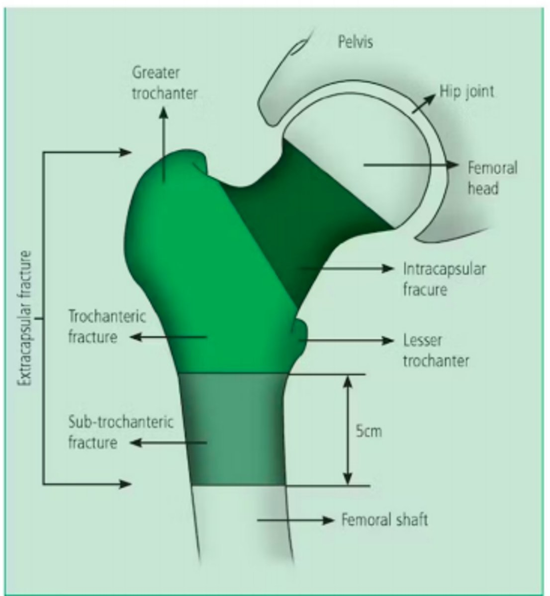 <p>Neck of femur fractures</p>