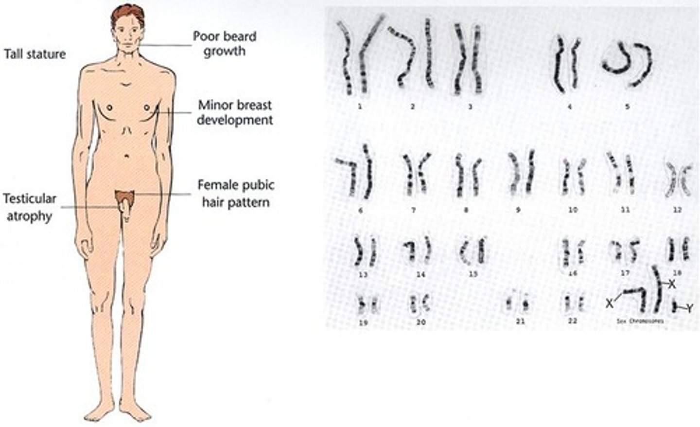 <p>47,XXY; male with extra X chromosome.</p>