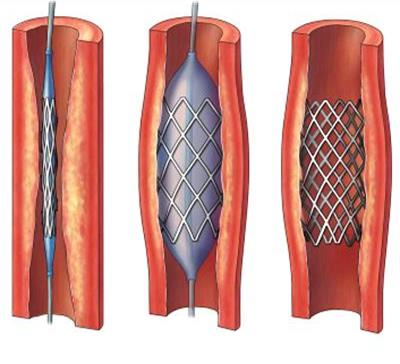 <p>Angioplasty</p>