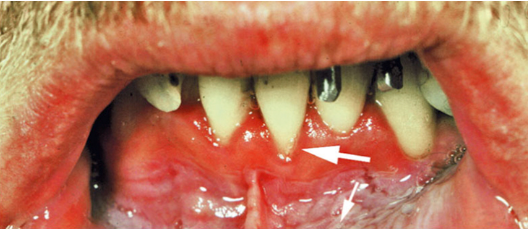 <p>49. What is a possible cause of the recession seen in Fig. 5.30?</p><p>a. Labial frenum attachment</p><p>b. Chewing tobacco</p><p>c. Toothbrushing</p><p>d. All of the above</p>