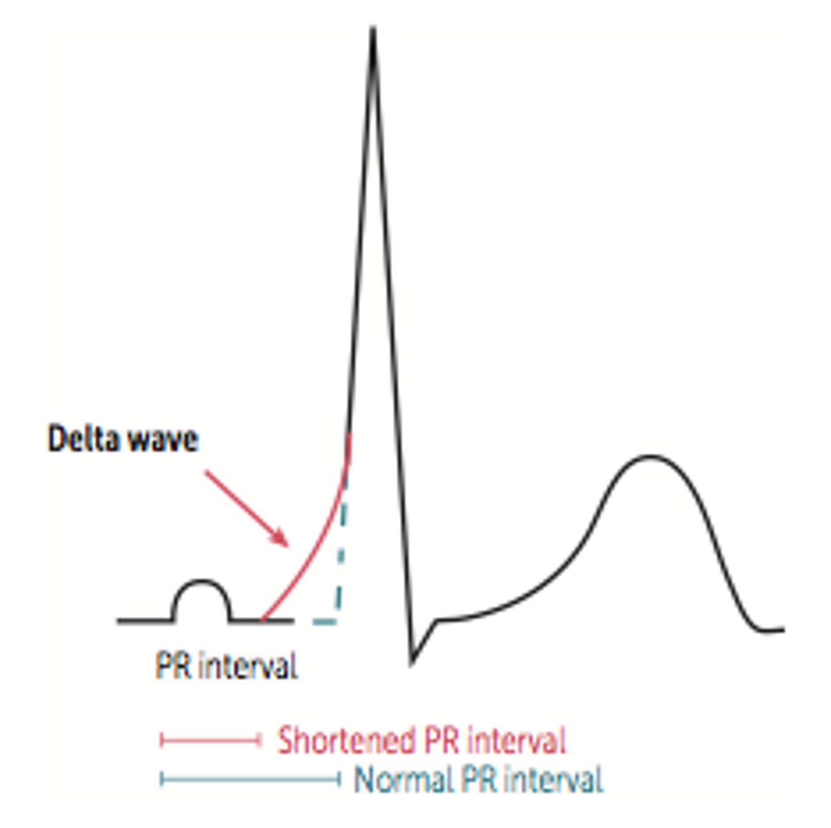 <p>Type of ventricular preexcitation syndrome where there is an accessory AV conduction pathway called the bundle of Kent (is a form of AVRT); leads to premature ventricular depolarization resulting in a delta wave (slurred QRS upstroke), short PR interval, &amp; wide QRS complex</p>