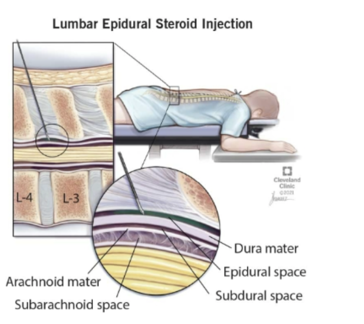 Space between the spinal dura mater and the periosteum of the vertebral column; pain medicine and anesthesia is injected into this space along the spine