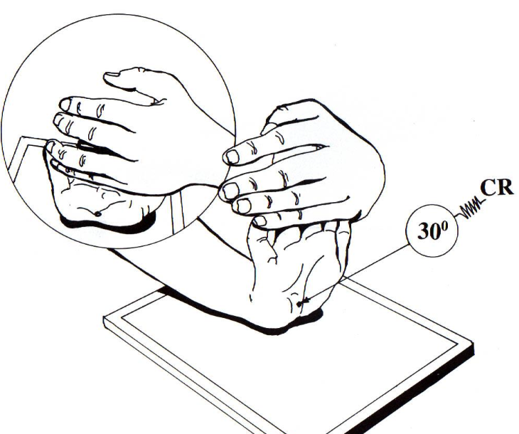 <p>carpal canal</p><ul><li><p>hand held back&nbsp;</p></li><li><p>CR rotated 30°</p></li></ul><p></p>