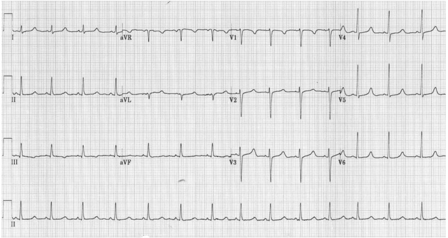 <p>45 y/o male patient presents to the ER after a seizure. Past medical hx is positive for thyroid cancer which was removed via complete thyroidectomy 1 week ago. Physical exam shows a positive chvostek and trousseaus sign. Vitals WNL. Lab work is as follows PTH low, corrected calcium under 7.5 mg/dl, high serum phosphate, low Mg. What is your treatment plan?</p>