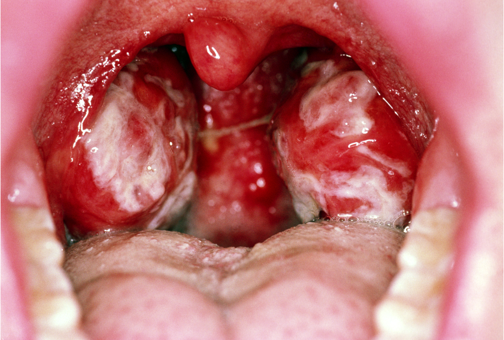 <p>What is this referring to</p><ul><li><p>Fever</p></li><li><p>Posterior cervical lymphadenopathy</p></li><li><p>Hepatosplenomegaly</p></li><li><p>Palatal petechiae</p></li><li><p>Tonsillar exudate</p></li><li><p>+/- rash</p></li></ul><p></p>