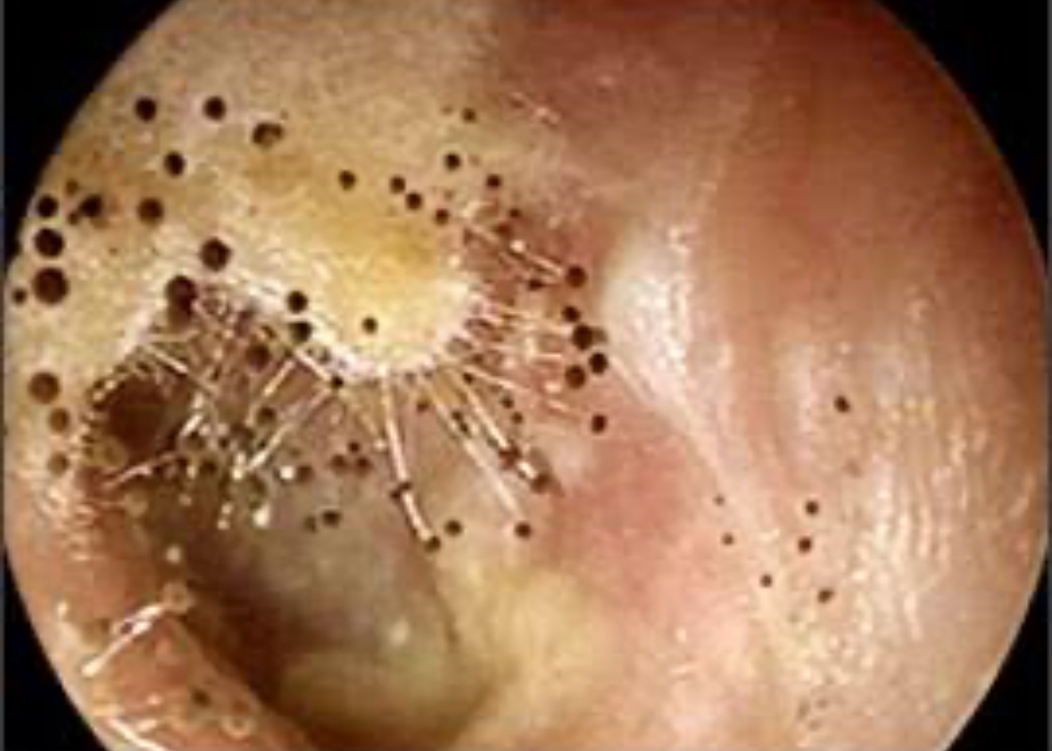 <p>Location: External Auditory Canal</p><ul><li><p>Fungal infection</p><ul><li><p>Itching</p></li><li><p>Possible pain</p></li><li><p>Burning</p></li><li><p>Discharge</p></li><li><p>Hearing loss</p></li></ul></li></ul><p></p>