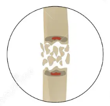 <p>Bone shatters into several pieces and lie in the surrounding tissue</p>