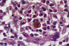 <p>Medlar bodies are <strong>muriform (brick arrangement) fungal cells</strong> with:</p><ul><li><p class=""><strong>Chestnut brown pigmentation</strong> from <strong>melanin</strong> in the cell wall</p></li><li><p class=""><strong>Internal septation</strong> (horizontal and vertical walls), giving a cross-sectioned appearance</p><p class=""></p></li></ul><p>They are used to diagnose chromblastomycosis</p>