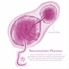 <p>Placenta Succenturiata</p>