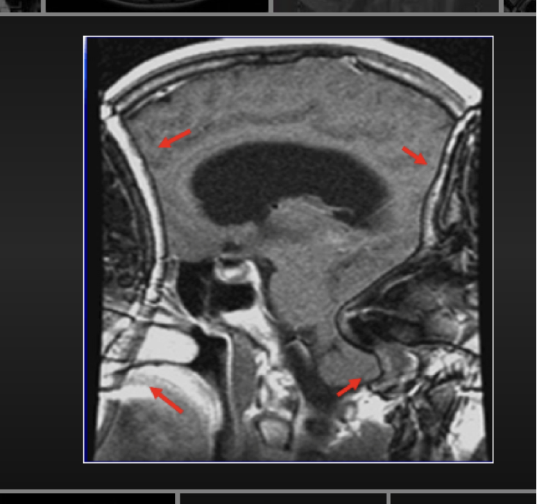 <p>Wrap or aliasing produces an image where the anatomy that exists outside the FOV is folded onto the top of the anatomy inside the FOV.&nbsp;</p>