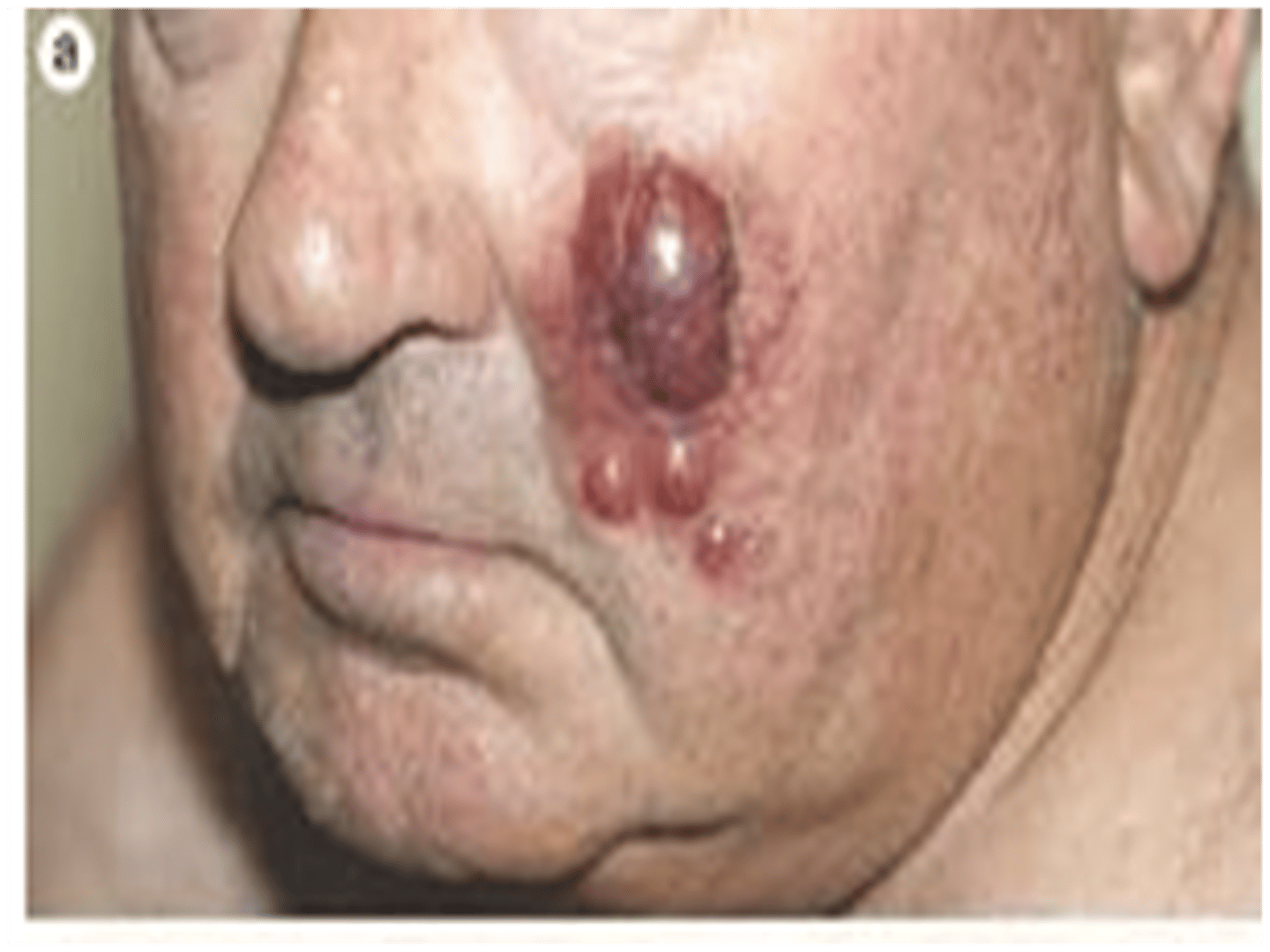 <p>-merkel cells (base of epidermis, connected to nerves)</p><p>-flesh-colored or bluish-red nodule</p><p>-often on face, head, or neck</p><p>-Merkel cell polyomavirus</p><p>-surgery, radiation therapy, etc for treatment</p>