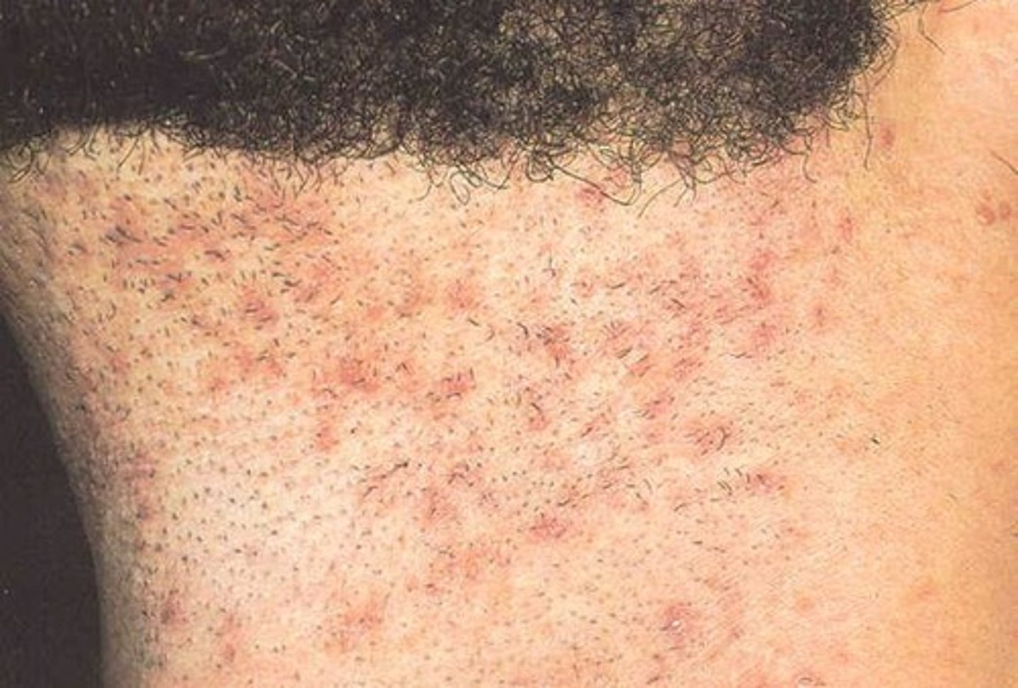<p>AKA razor bumps</p><p>FB inflammatory rxn surrounding ingrown hairs from shaving</p>