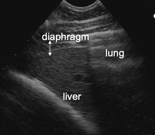 <p>ultrasound</p><p>must know normals! (architecture, expected size, comparison to spleen)</p>