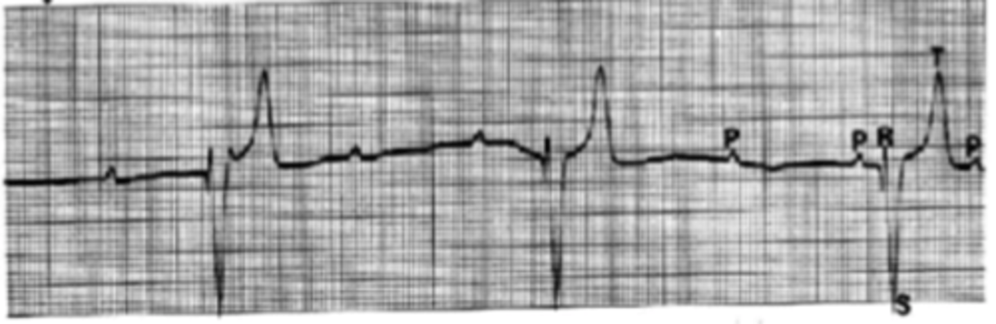 <p>Describe EKG of lead II</p>