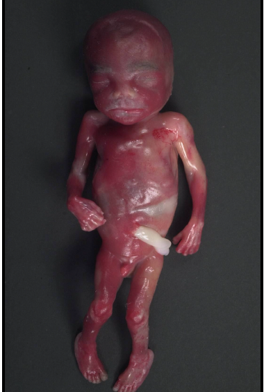 <p>degenerative changes in fetal tissue when retained in utero</p>