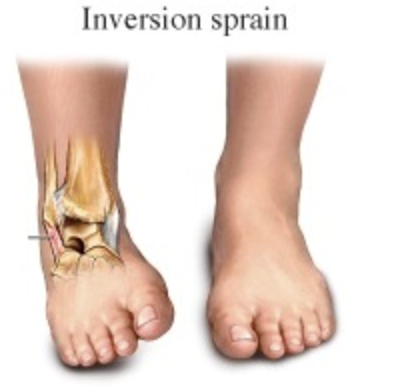 <p>Ankle Inversion  </p>