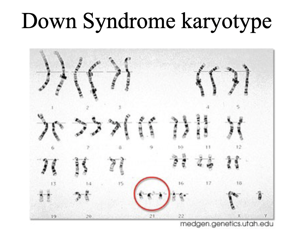 <ul><li><p>Only case in humans where you can survive past infancy with an extra chromosome</p></li><li><p>Results from an extra copy of chromosome 21</p></li></ul>