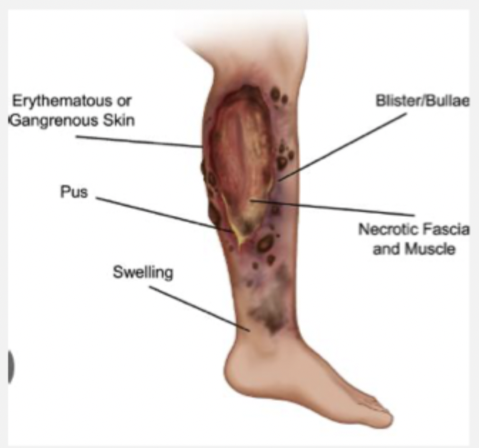 <p>A life threatening bacterial deep soft tissue infection that rapidly spreads along the fascial planes that can develop quickly and have high morbidity/mortality if not found promptly </p>