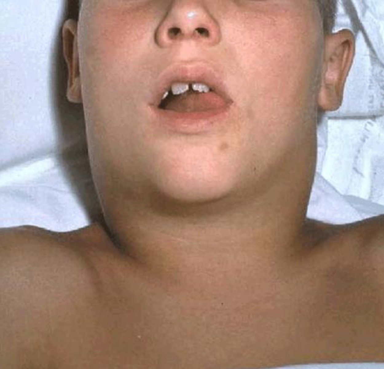 <p>Two or more symptoms of</p><p>- swollen lymph nodes, splenomegaly</p><p>- upper respiratory infections (sinusitis, otitis media)</p>