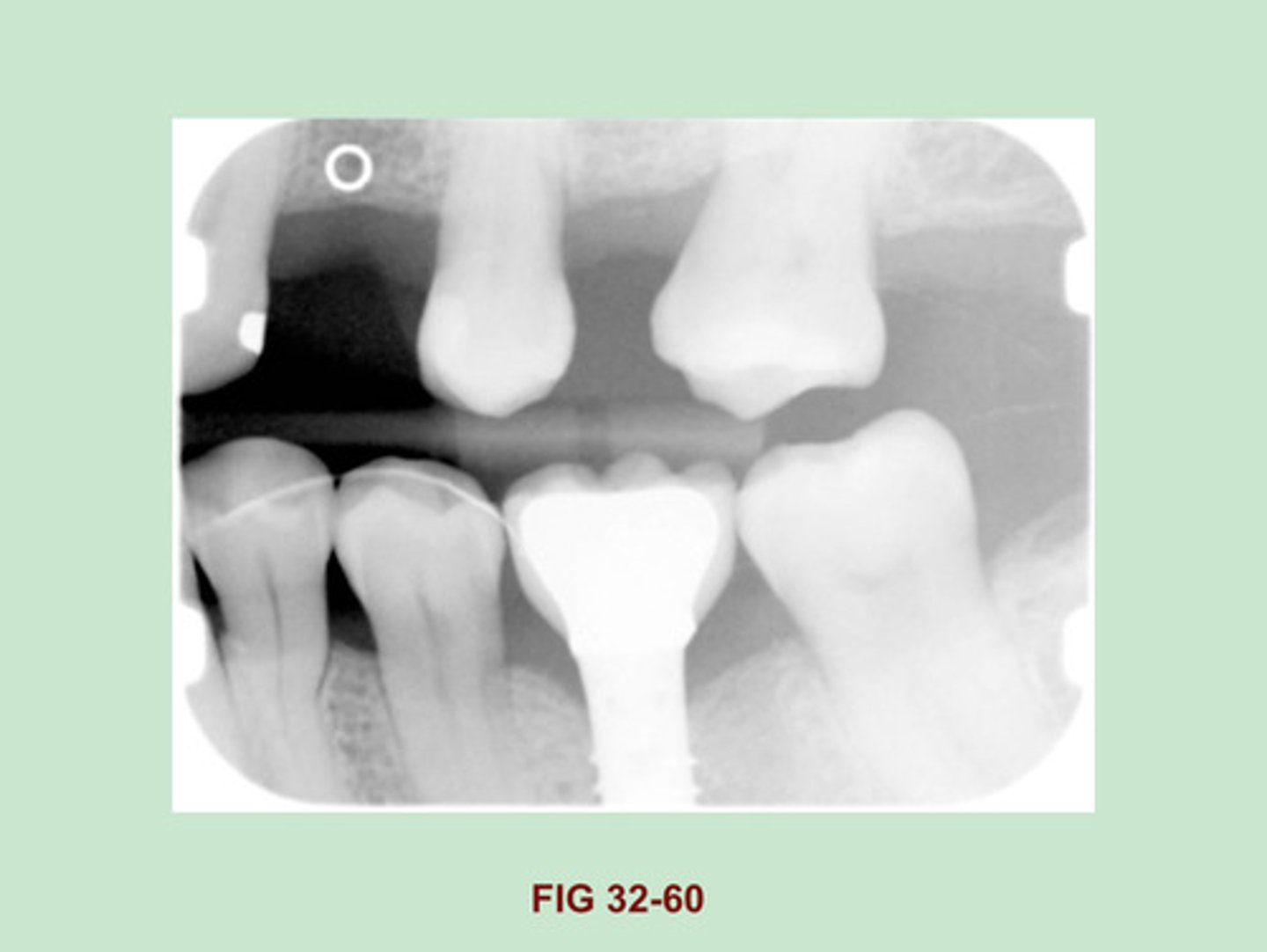 <p>Dental Implant (porcelain fused to metal)</p><p>Side Note: Implants are being used in oral surgery w/ INCREASED frequency. The appearance of the numerous ENDOSTEAL implants that are currently used vary. depending on their shapes & design. the ENDOSTEAL implant is made of a metallic material & appears radiopaque on a dental image.</p>