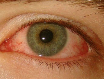 <ol><li><p>dryness of ocualr surface causes inflammation of the conj </p></li></ol><p></p>