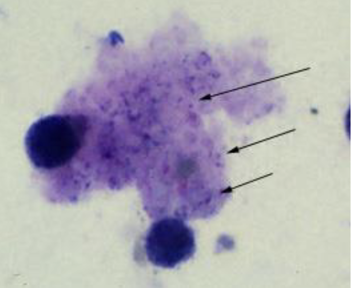 <p>Name: Pneumocystis jirovecii</p><p class="p1">Stage: cysts</p><p class="p1">(<span style="font-size: calc(var(--scale-factor)*11.04px);"><span>Cysts” in lung tissue/ Note 8 nuclei in mature cyst)</span></span></p><p class="p1"><span style="font-size: calc(var(--scale-factor)*11.04px);"><span>*Use photo from the atlas or yoders handout</span></span></p>