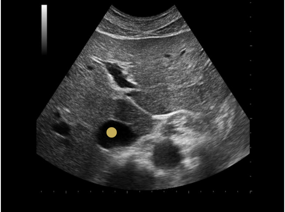 <p>IVC is posterior to caudate lobe</p>