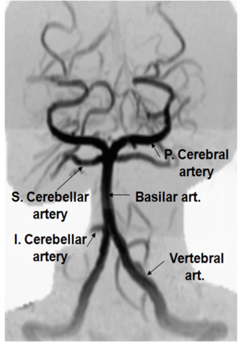 <p>What is the etiology of <strong>vertebral-basilar insufficiency</strong>?</p>
